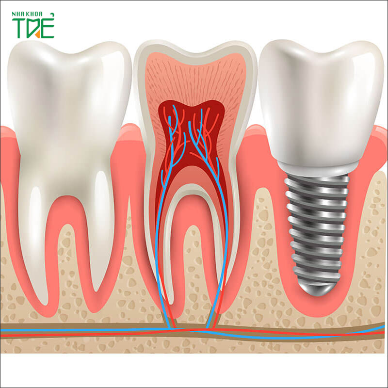 Trồng răng Implant số 7 có tốt không? Giá bao nhiêu?