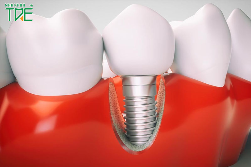 Răng Implant có cấu tạo tương tự răng thật