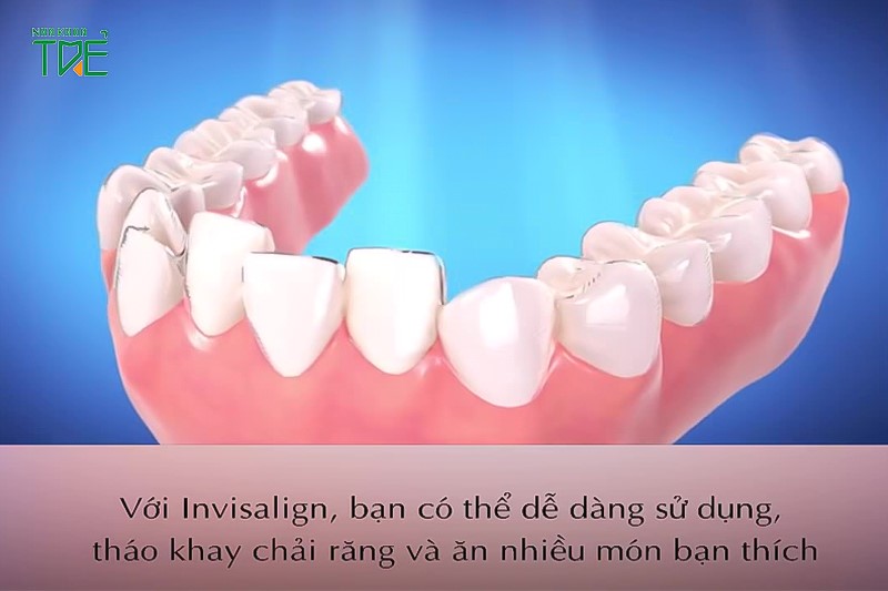 Invisalign khắc phục được những nhược điểm của niềng răng truyền thống