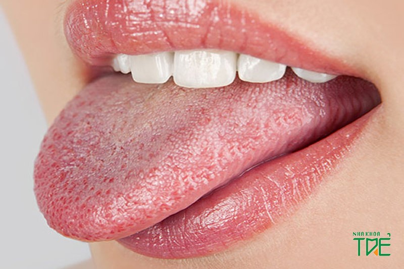 Bị tê lưỡi sau khi nhổ răng khôn phải làm sao?