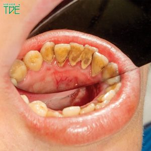 Cao răng tự rơi ra được không? Cách lấy cao răng hiệu quả nhất?