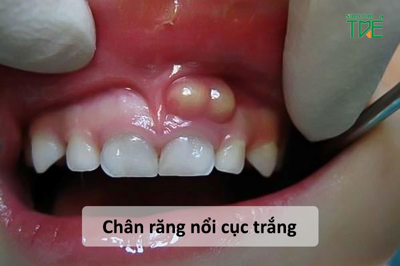 Chân răng nổi cục trắng là dấu hiệu của bệnh gì?