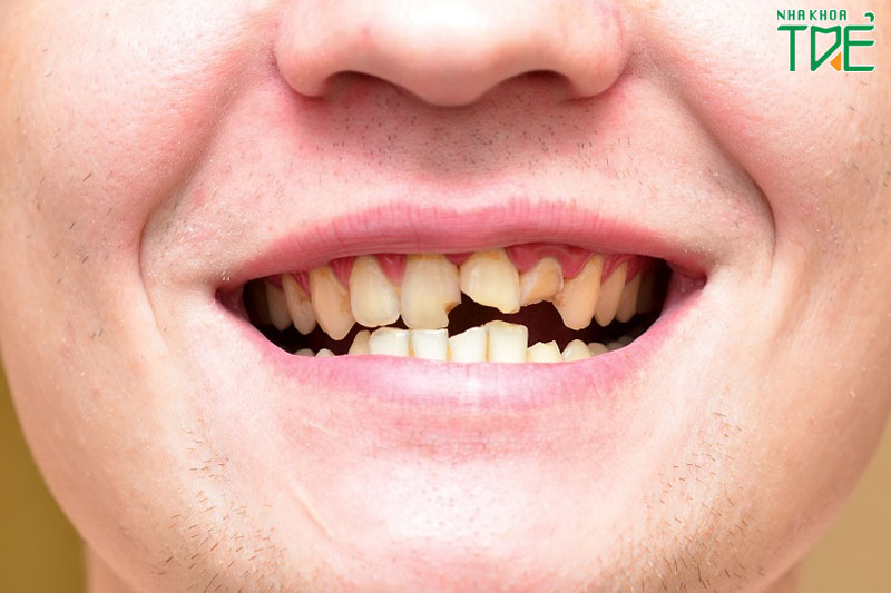 Răng sứt mẻ, gãy vỡ nên bọc răng sứ phục hình