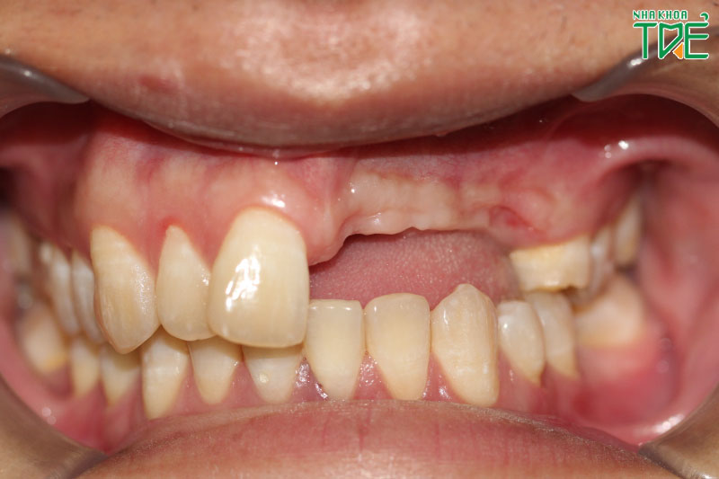 Hầu hết các trường hợp mất răng đều có thể trồng răng Implant