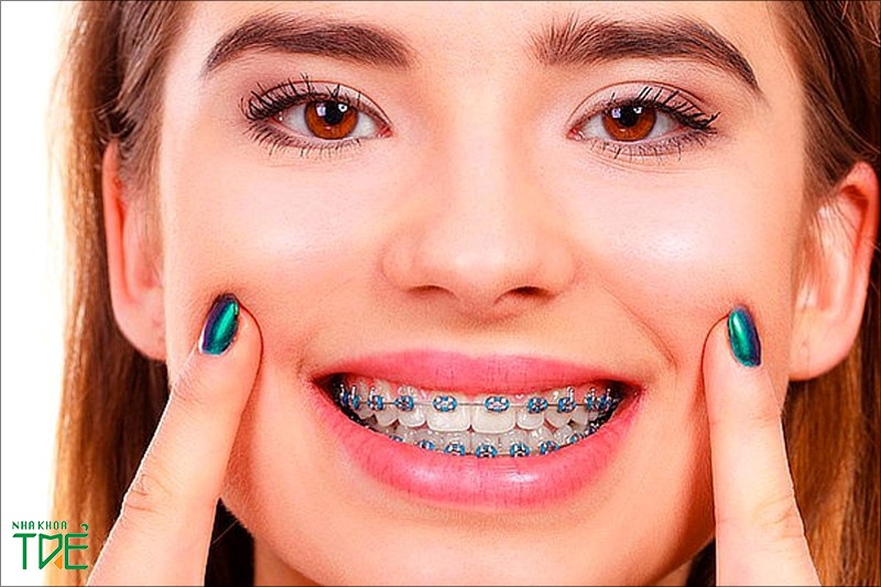 Niềng răng bao lâu siết một lần?