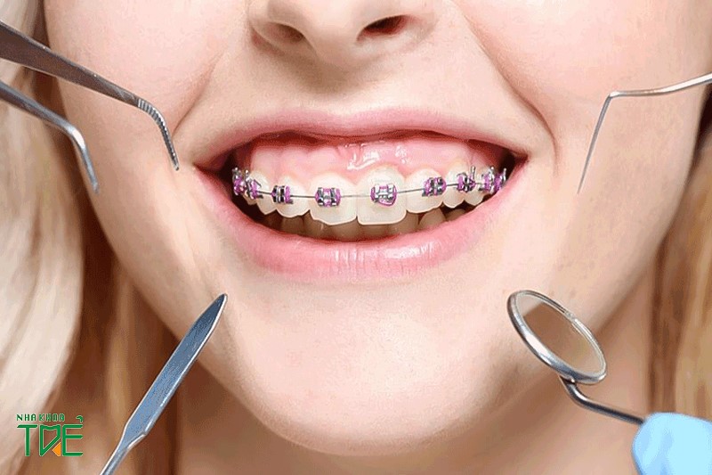 Cần siết răng khi chỉnh nha bởi răng dịch chuyển được nhờ lực tác dụng khi siết dây cung