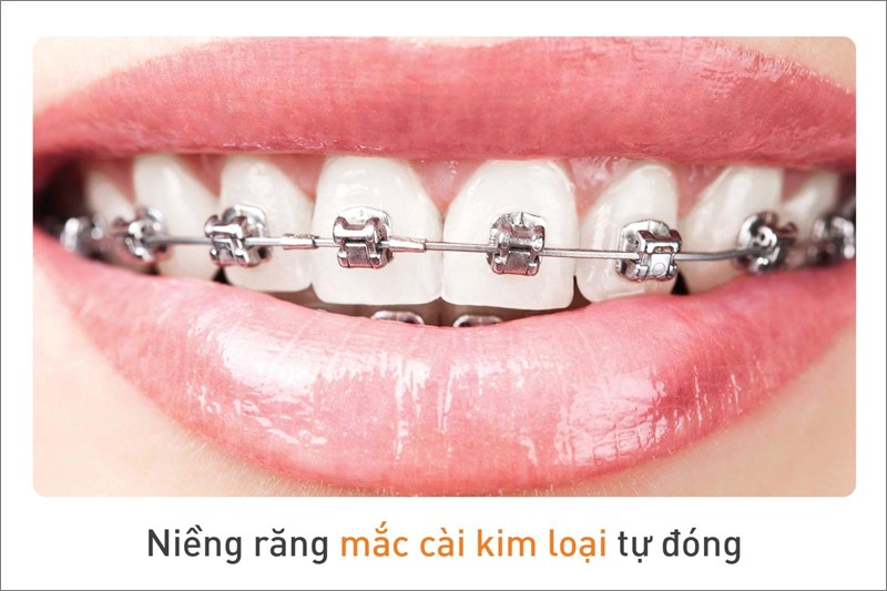 Tùy vào phương pháp chỉnh nha khác nhau sẽ có thời gian siết răng khác nhau