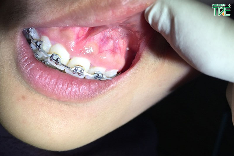 Biến chứng niềng răng bị bật chân răng cực kỳ nguy hiểm