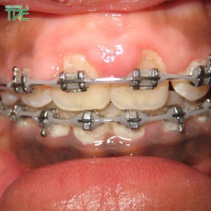 Niềng răng bị viêm lợi: Nguyên nhân và giải pháp khắc phục hiệu quả