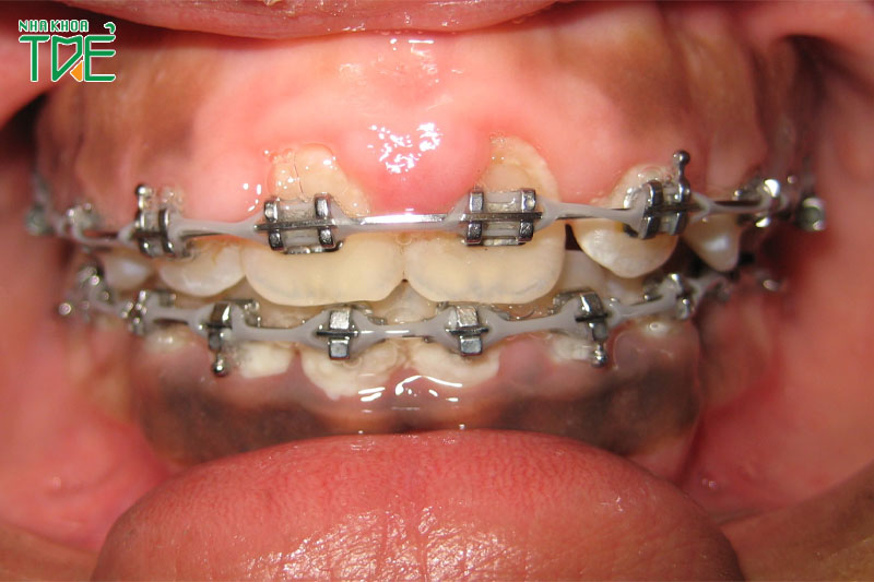 Niềng răng bị viêm lợi là do đâu?