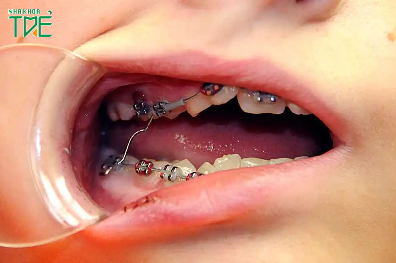Niềng răng bị viêm lợi gây biến chứng nguy hiểm