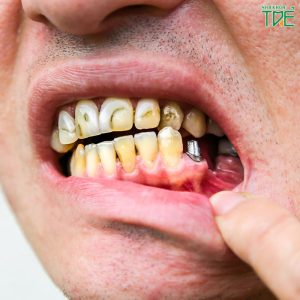 Răng Implant bị đào thải: Dấu hiệu nhận biết và cách xử lý hiệu quả