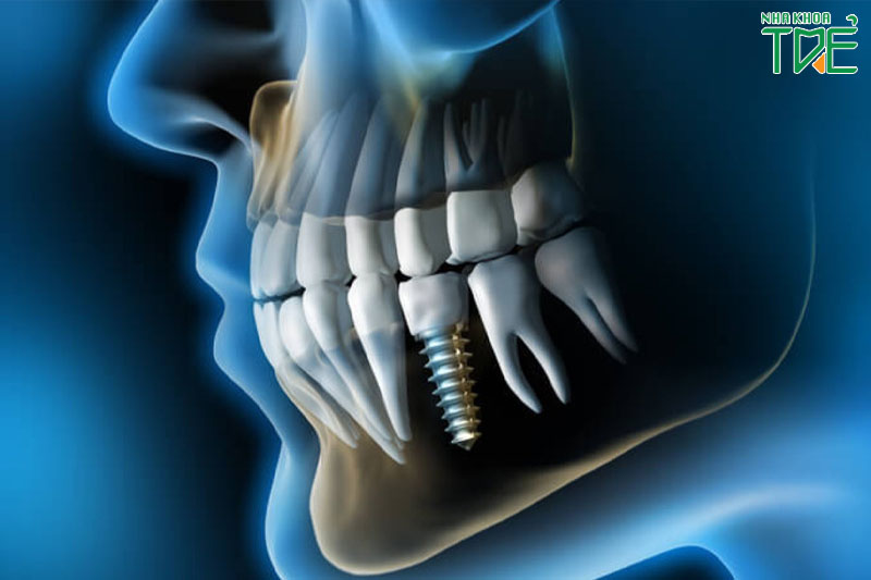Trồng răng Implant thực hiện cấy trụ Titanium vào trong xương hàm