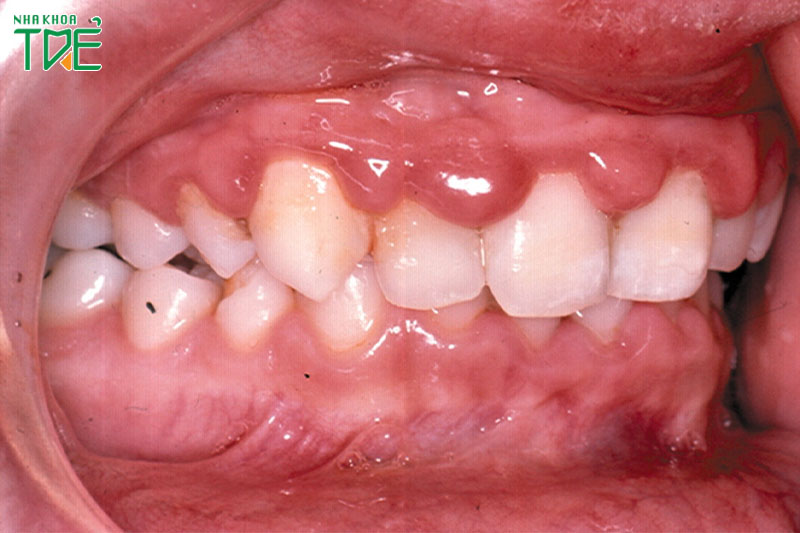 Viêm nướu răng ở trẻ em xuất phát do vi khuẩn bám ở chân răng
