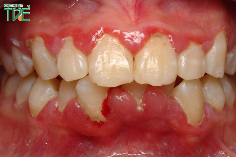 Viêm nướu răng nặng sẽ lan rộng và làm tiêu xương hàm