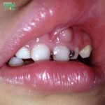 Viêm nướu răng ở trẻ em phải làm sao? Cách phòng ngừa thế nào?