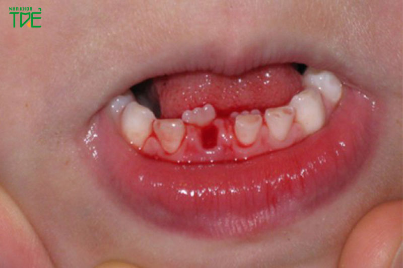 Chấn thương răng sữa khiến răng xiên vẹo