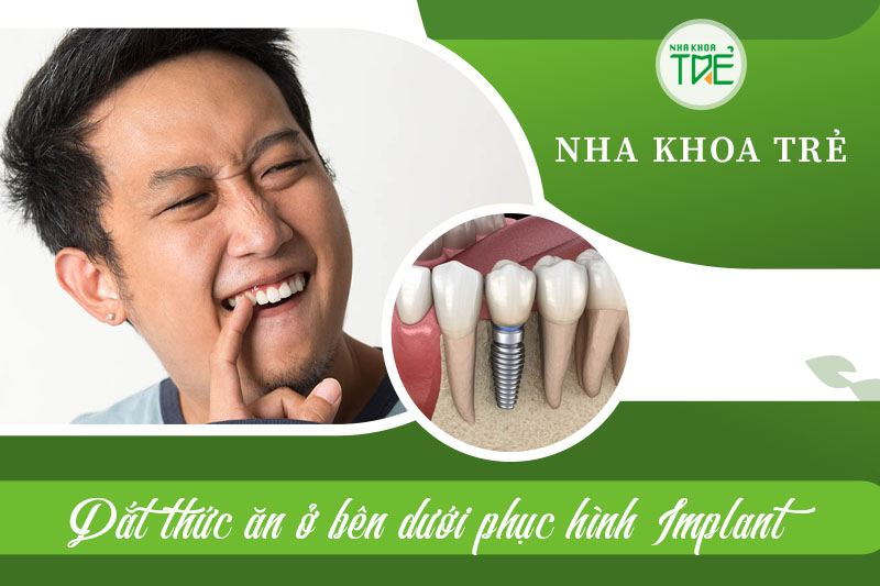 Dắt thức ăn dưới răng Implant gây khó chịu cho người bệnh