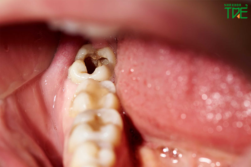 Sâu ngà răng khiến răng nhạy cảm 