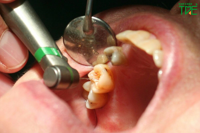 Điều trị tủy răng khi bị sâu nặng