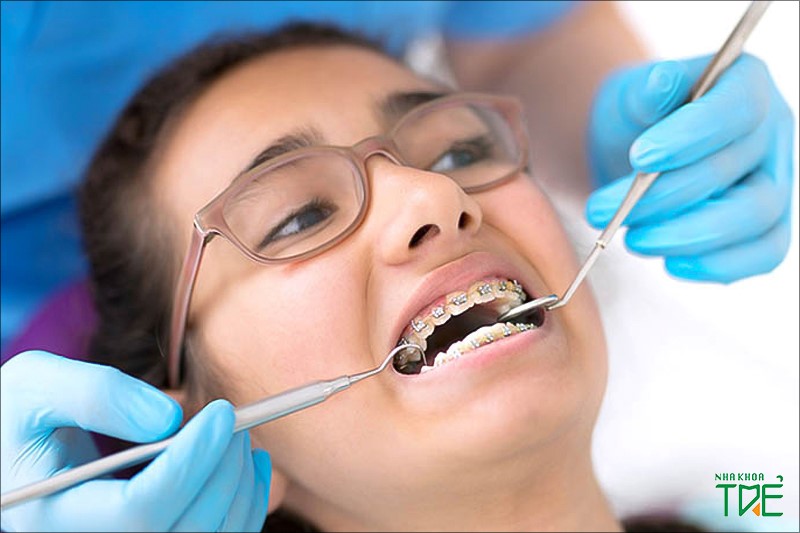 Những tai nạn niềng răng có thể gặp phải là gì?
