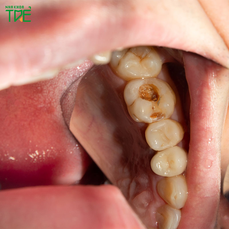 Cảnh giác: Vị trí dễ sâu răng nhất và cách phòng ngừa hiệu quả
