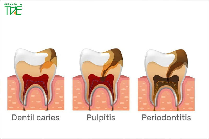 Dấu hiệu sâu răng theo từng giai đoạn 