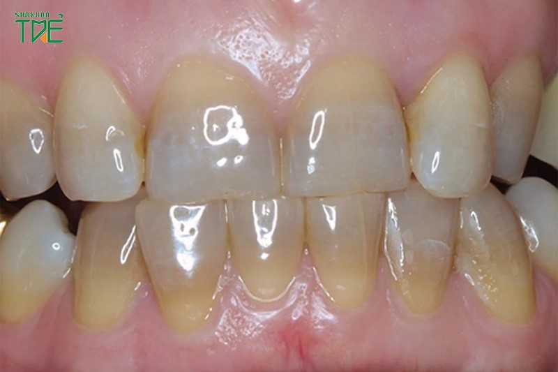 Răng ố vàng, nhiễm kháng sinh nên bọc răng sứ