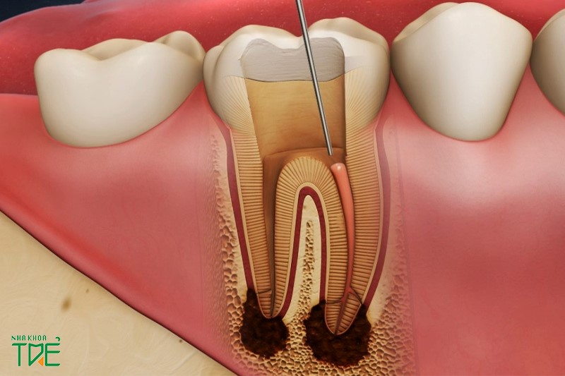 Răng hư, chết tủy cần bọc răng sứ để khắc phục