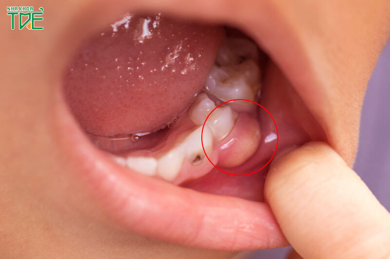 Áp xe răng có thể gặp phải ở trẻ em