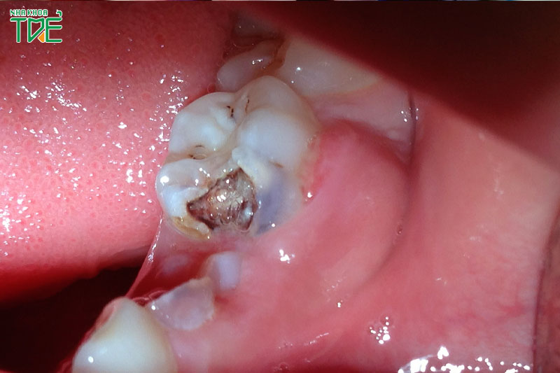 Nguy cơ mất răng do áp xe răng kéo dài