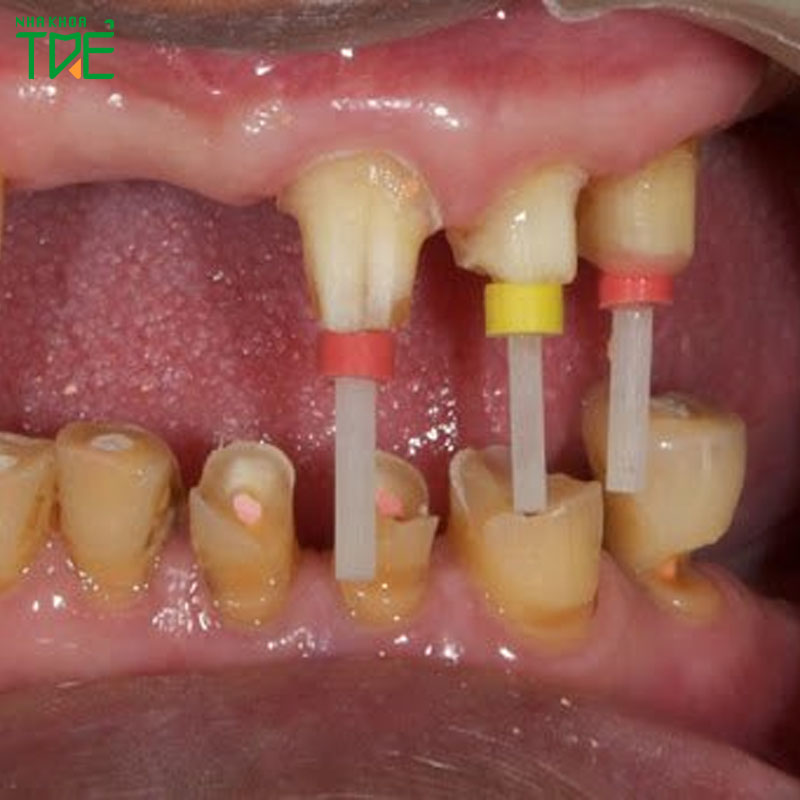 Cắm chốt răng – Giải pháp bảo tồn răng thật sau chữa tủy