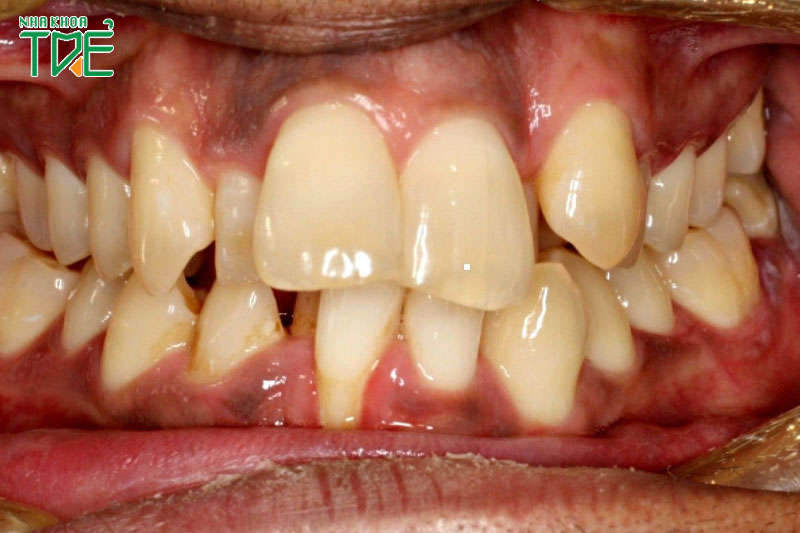 Hậu quả đặt lưỡi sai tư thế khiến răng khấp khểnh, chen chúc