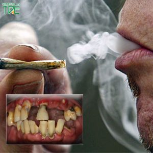 Mối liên hệ giữa hút thuốc lá và viêm nha chu