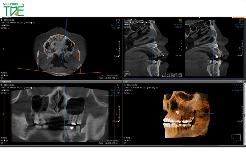 Chụp X-quang răng 3D để chẩn đoán tình trạng răng miệng