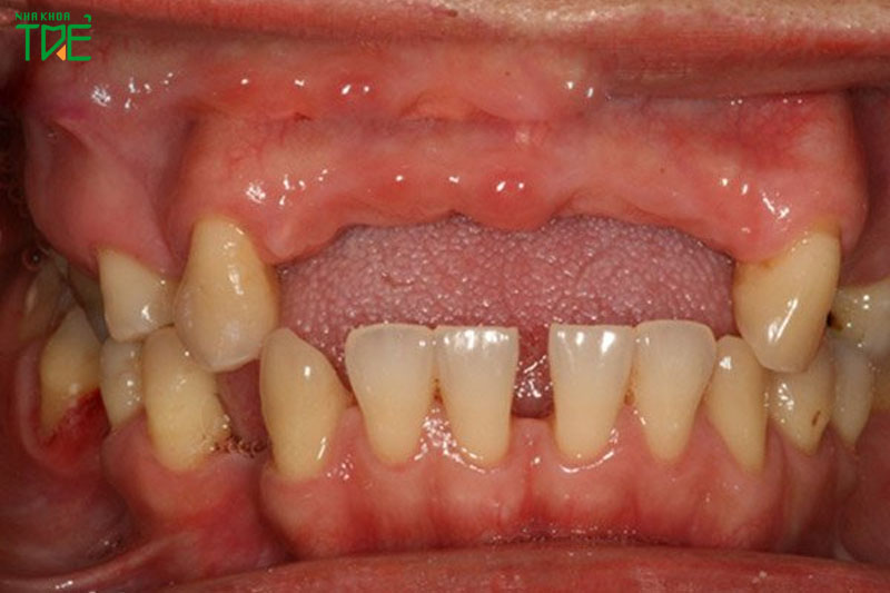 Tình trạng tiêu xương xảy ra sau một thời gian mất răng