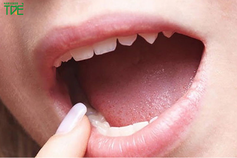 Mất cân bằng áp lực môi má và lưỡi có thể gây tái phát sau chỉnh nha