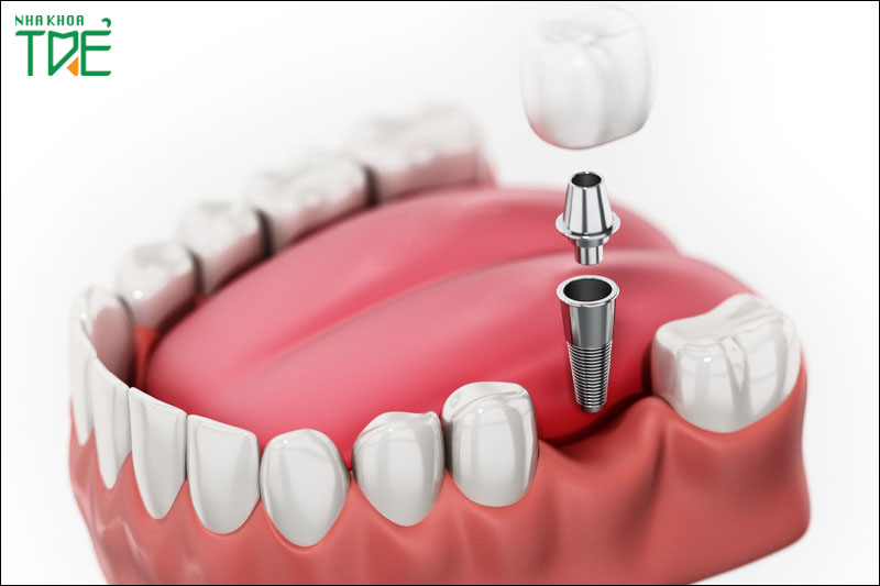 Trồng răng Implant là phương pháp được ưu tiên