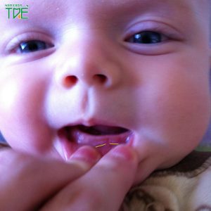 Trẻ 3 tháng mọc răng sớm: Nguyên nhân và cách chăm sóc hiệu quả