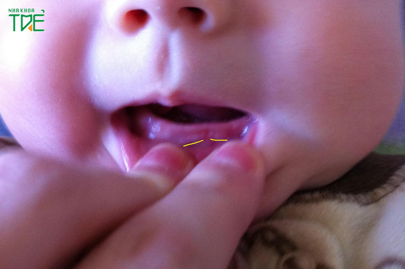 Trẻ 3 tháng mọc răng sớm: Nguyên nhân và cách chăm sóc hiệu quả