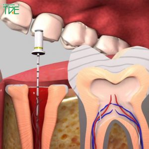 Triệu chứng sau lấy tủy răng bất thường cần cảnh giác