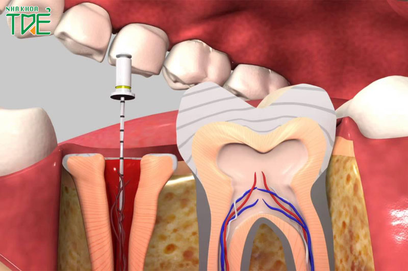 Triệu chứng sau lấy tủy răng bất thường cần cảnh giác