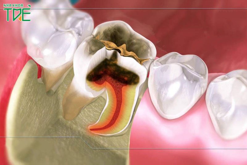 Răng viêm tủy, hoại tử tủy cần điều trị ngăn ngừa viêm nhiễm lan rộng