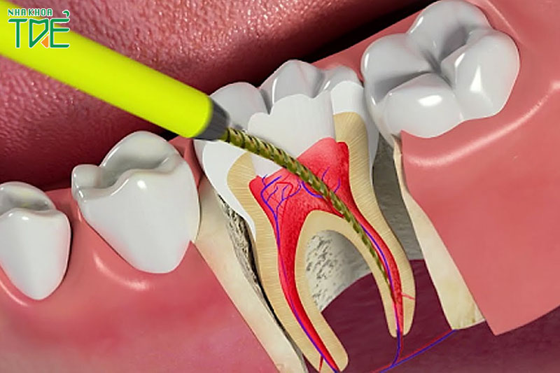 Điều trị lại tủy răng khi có triệu chứng bất thường