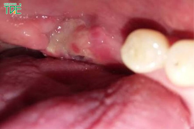 Xuất hiện màng trắng sau nhổ răng – Những vấn đề đáng lưu ý