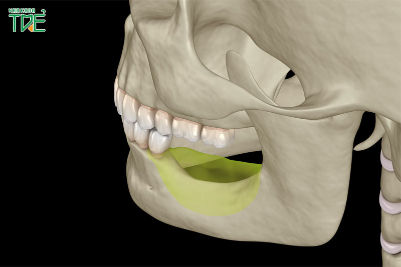 Xương hàm mỏng bị thiếu hụt thể tích, mật độ xương hàm