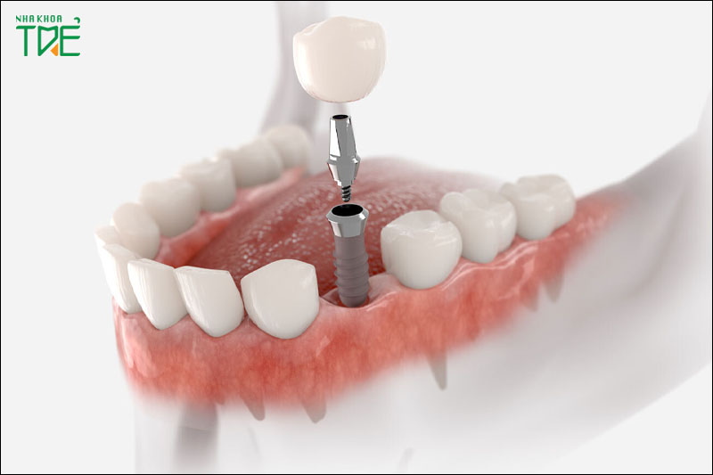 Trồng răng Implant - ngăn ngừa biến chứng tiêu xương hàm