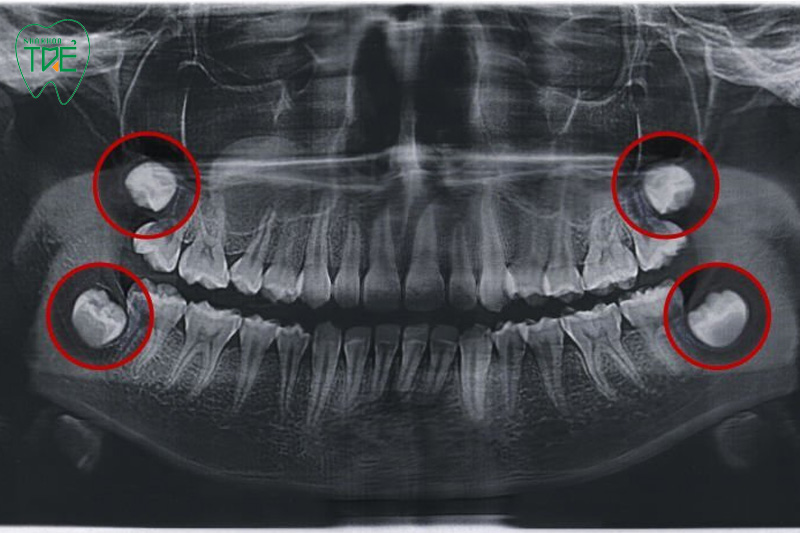 Răng khôn là răng hàm lớn số 3 nằm trong cùng