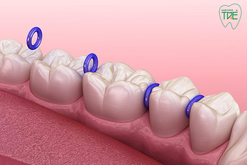 Chun tách kẽ thường đặt ở răng hàm