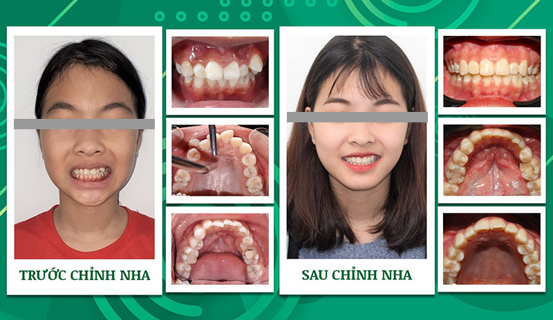 Hình ảnh trước và sau niềng răng của khách hàng Nha khoa Trẻ